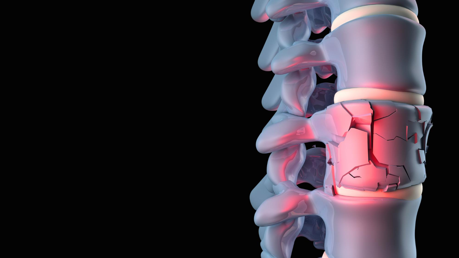 Imagem relacionada à fratura de coluna vertebral